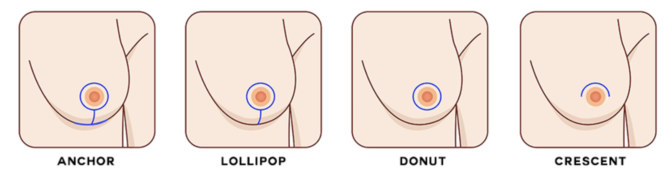 breast lift incision types