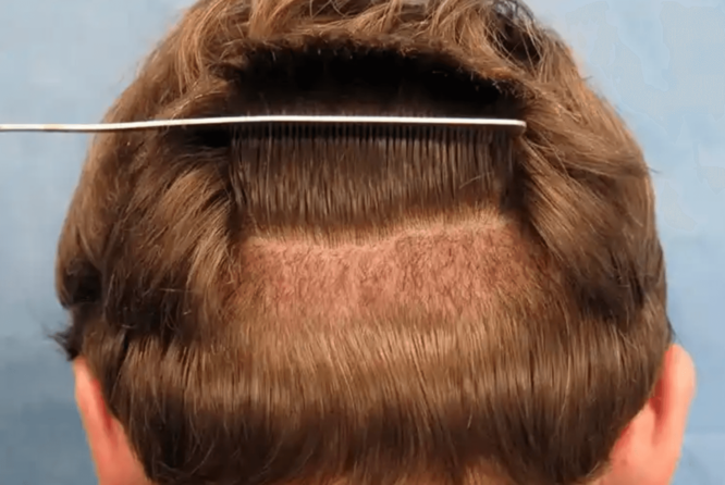 infection in hair transplant